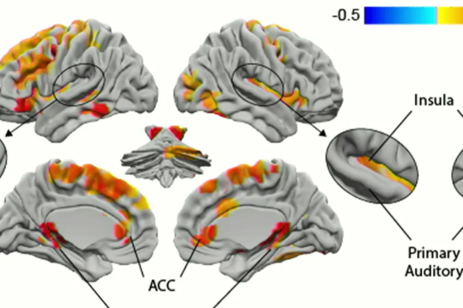 Color mapping of psilocybin reflect in various areas of the brain